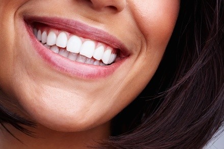 Up to 50% Off on Teeth Whitening - In-Office - Non-Branded at Luxy Beauty