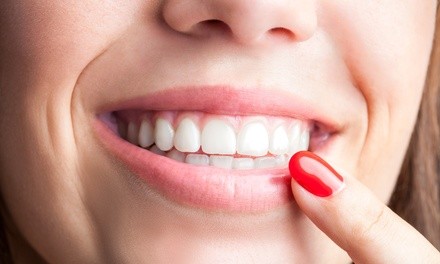 Up to 40% Off on Teeth Whitening - Traditional at Raresourceful Smiles