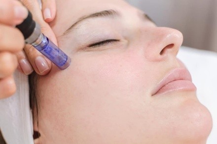 Up to 44% Off on Micro-Needling at Northern Skin Studio