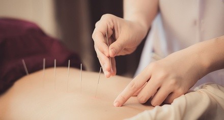 Up to 80% Off on Acupuncture Services at Advance Healing Clinic