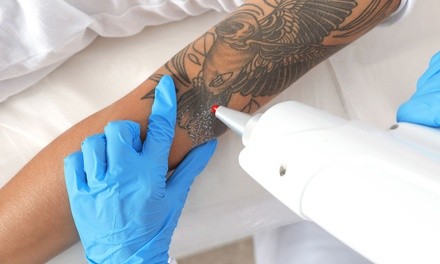 One Laser Tattoo-Removal Session on a Small or Medium Area at St Croix Skincare (Up to 75% Off)