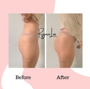 Up to 57% Off on Cavitation at RejuveLux Wellness