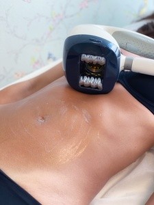 One, Three, or Six VelaShape Treatments at DermaClinic (Up to 58% Off)