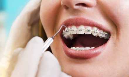 $39 for $1,500 Toward a Complete Braces Package at Embrace Dental