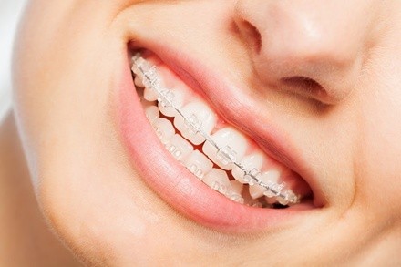 $59 for $500 Worth of Clear Braces at Premier Orthodontics