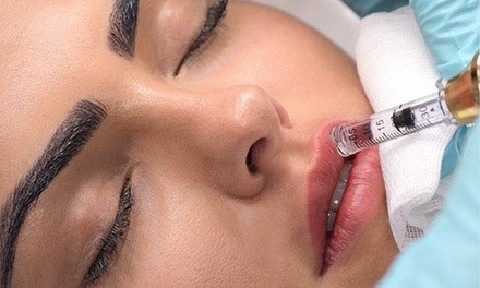 $250 for Two Syringes of Hyaluronic Lip Filler at Modern Sculpting ($600 Value)