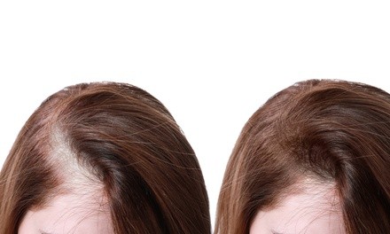 One or Two Scalp-Micropigmentation Hair-Loss Treatments at Revive Spa (Up to 56% Off)