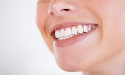 Up to 54% Off on Teeth Whitening - In-Office - Branded (Zoom, Brite Smile) at Aja's
