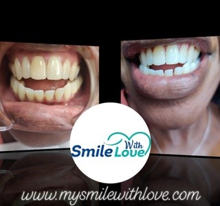 Up to 70% Off on Teeth Whitening - In-Office - Branded (Zoom, Brite Smile) at Smile With Love