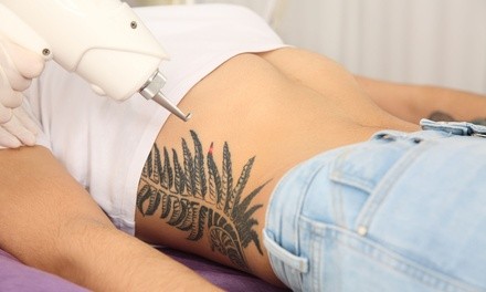 Three Tattoo-Removal Sessions on an Area Up to 3, 6, or 12 Square Inches at Advanced Skincare (Up to 86% Off)