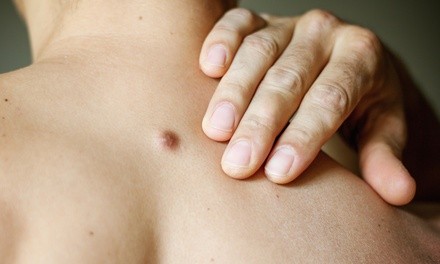 Removal of One, Three, or Five Skin Tags at Century Med Spa (Up to 68% Off)