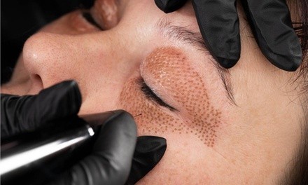 Fibroblast Plasma Treatment at Doors To Heaven Spa (Up to 60% Off). Three Options Available.