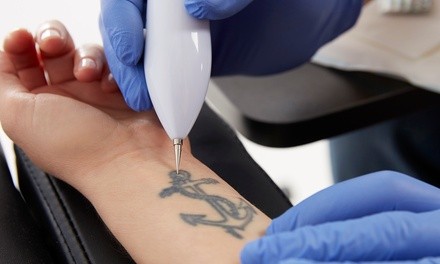 Q-SWITCHED Laser Tattoo-Removal Treatments at Manhattan Laser Spa (Up to 70% Off). Three Options Available.
