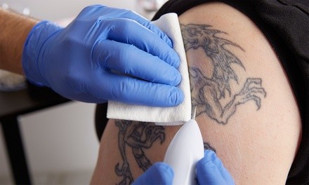 Laser Tattoo Removal Sessions at Madison Family Care Aesthetic Center (Up to 63% Off). 