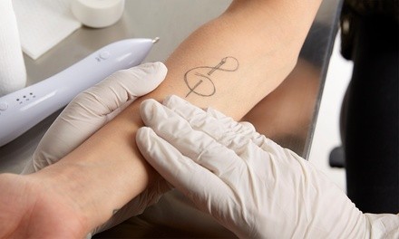 One Laser Tattoo-Removal Session on One Area Up to 2 or 4 Square Inches at ThermaSlim (Up to 84% Off)
