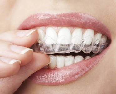 Up to 96% Off on Braces - Invisible - Branded (Invisalign) at The smile mission