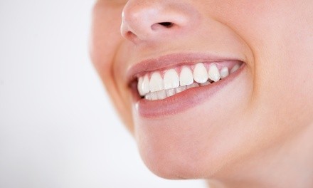 Up to 50% Off on Dental Checkup (Cleaning, X-Ray, Exam) at Fresh Dental Care