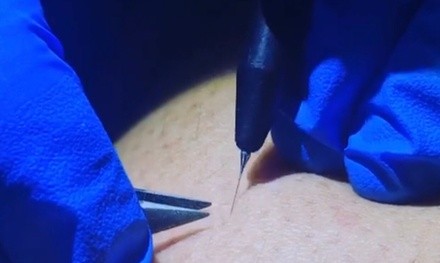 One or Two 30- or 60-Minute Electrolysis Treatments at PF International Salon (Up to 53% Off). Four Options.