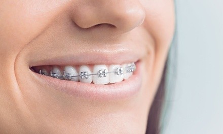 $39 for $1000 Value Towards Orthodontic Treatment with Consultation at Southpark Family Dental Care