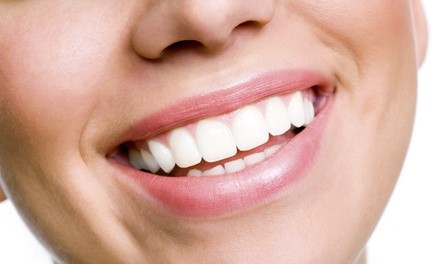 60-Minute Teeth-Whitening Session at Tranquility Day Spa (Up to 59% Off) 