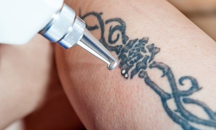 Tattoo Removal at Advanced Laser Aesthetics, LLC (Up to 81% Off). Four Options Available.