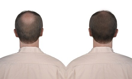 One, Two, or Three PRP Hair-Restoration Sessions at Dr. Shaun Dyler (Up to 66% Off)