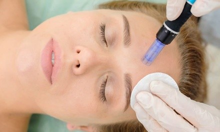 One Microneedling Session at Leblanc (Up to 28% Off)