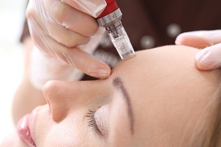 Up to 55% Off on Micro-Needling at Skincare by Sol