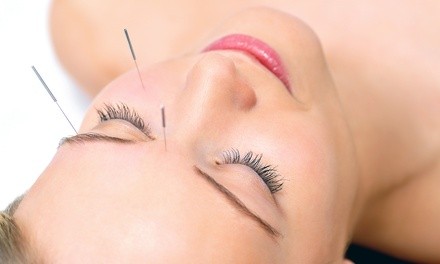 One or Two Acupuncture Sessions at Cedros Natural Health Center (Up to 50% Off)