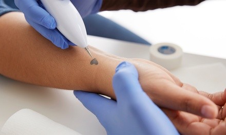 One Laser Tattoo-Removal Session for One, Small, Medium, or Large Area at Begin Anew Med Spa (Up to 51% Off)