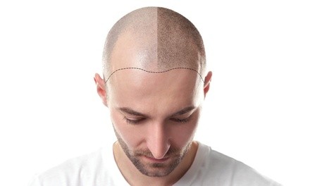 Full Scalp Micropigmentation or Scar Cover-Up at Mac SMP (Up to 85% Off)