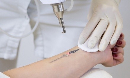 Three Tattoo-Removal Sessions on an Area of Up to 5, 10, or 15 Square Inches at dr LASER (Up to 80% Off)