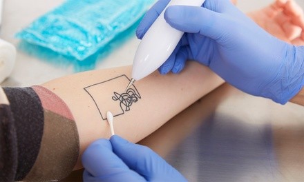 Up to 56% Off on Tattoo Removal at Kryptonite Tattoo Removal