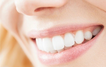 Up to 34% Off on Teeth Whitening - In-Office - Non-Branded at afterglo