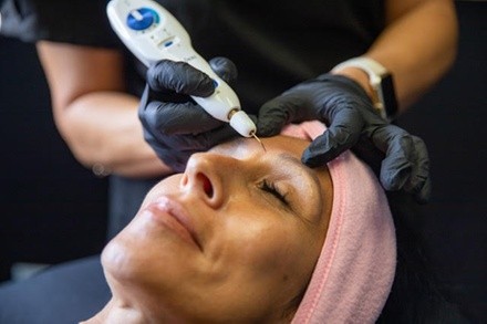 Fibroblast Skin-Tightening Treatments at The Beauty Hut Face & Body Sculpting (Up to 44% Off). Four Options.