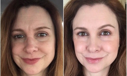 Up to 50% Off on Facelift - Non-Surgical at Inspire Beauty