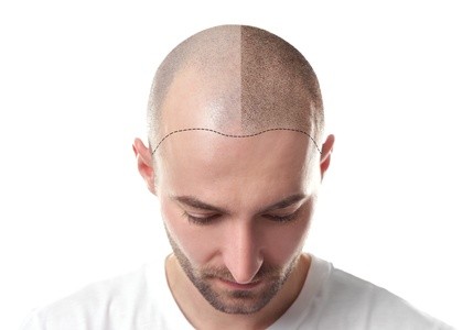 Up to 90% Off on Hair Restoration - Other at Exclusive Experience Company