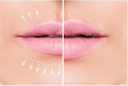 $239.20 for Hyluronic Pen Lip Filler at Skincare and Moore ($400 Value)