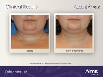 $3,500 for Five Non-Invasive Facelifts with Ultrasound and More at Cleveland Health Group ($5,000 Value)