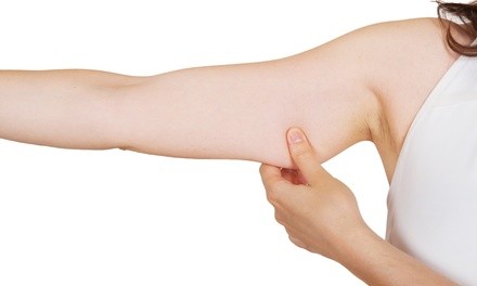 Two, Four, or Six Non-Invasive Arm Fat-Reduction Treatments at Brilliant Body Contouring (Up to 91% Off)