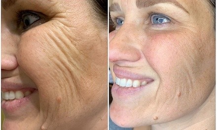 Up to 60% Off on Laser Skin Resurfacing at Brow chika wow wow