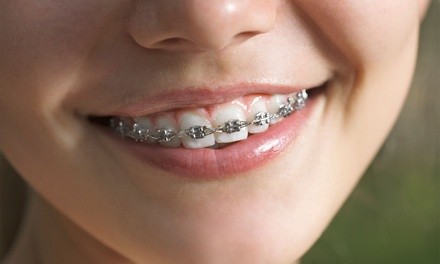 $20 for $2,000 Towards Braces or Invisalign Package at Calismile Orthodontics