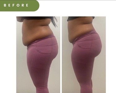 Up to 45% Off on Fat / Cellulite Reduction - Non-Branded at Bloom Body Company