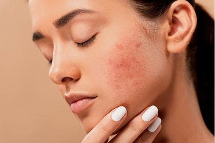 Up to 60% Off on Acne Treatment (Service) at DERMA M