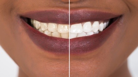 Up to 45% Off on Teeth Whitening - Traditional at Natara Haus