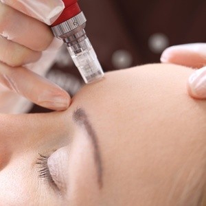 Up to 50% Off on Micro-Needling at Bagliore Spa