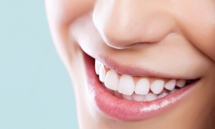 Up to 30% Off on Teeth Whitening - Traditional at D’Lightful beauty