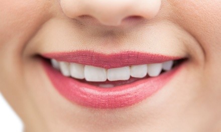 Up to 59% Off on Teeth Whitening - In-Office - Non-Branded at Aesthetics by Alyssa