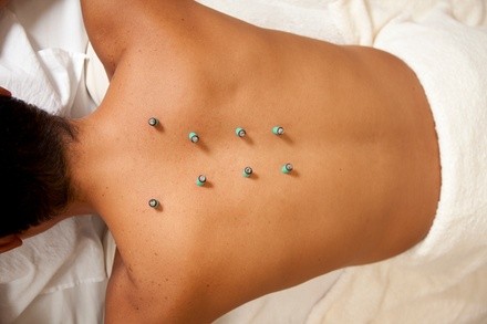 Up to 55% Off on Acupuncture Services at CN Acupuncture Clinic