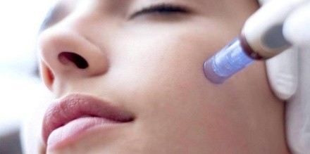 Up to 64% Off on Micro-Needling at Aesthetics On Highland